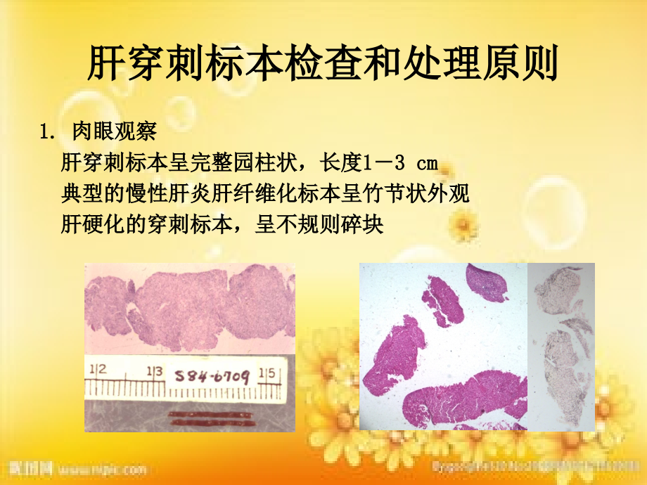 肝病的病理形态特点及免疫组化染色体会.ppt_第2页