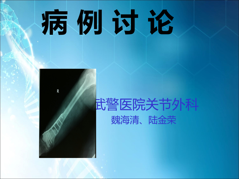 股骨肿瘤.ppt_第1页