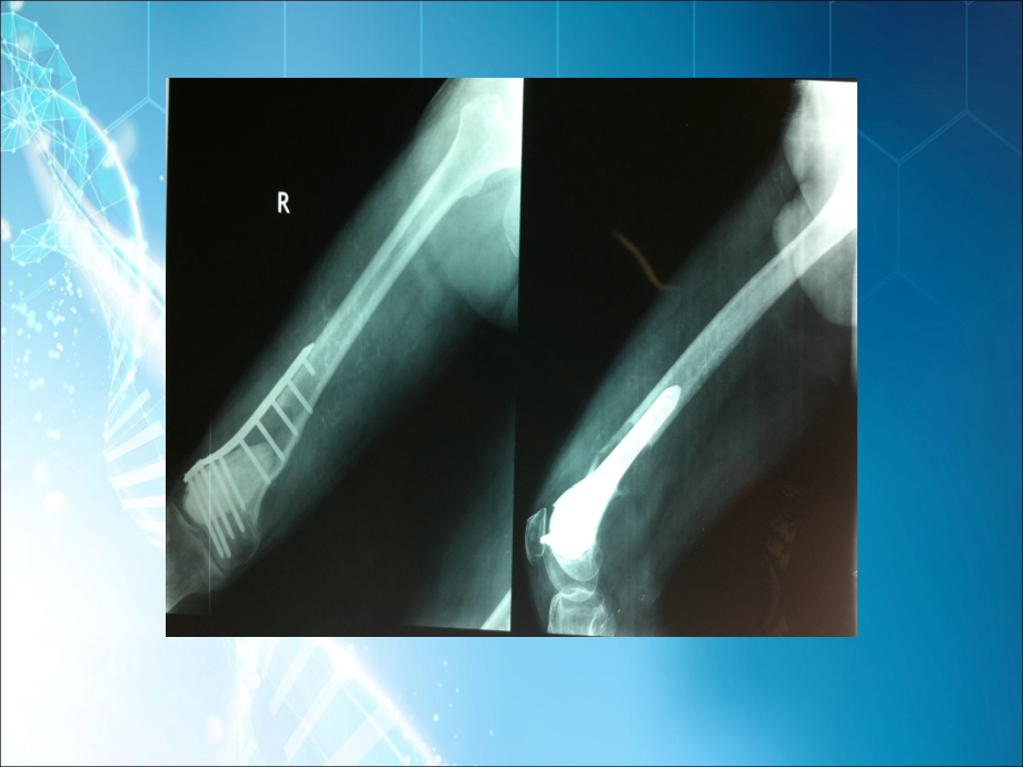 股骨肿瘤.ppt_第2页