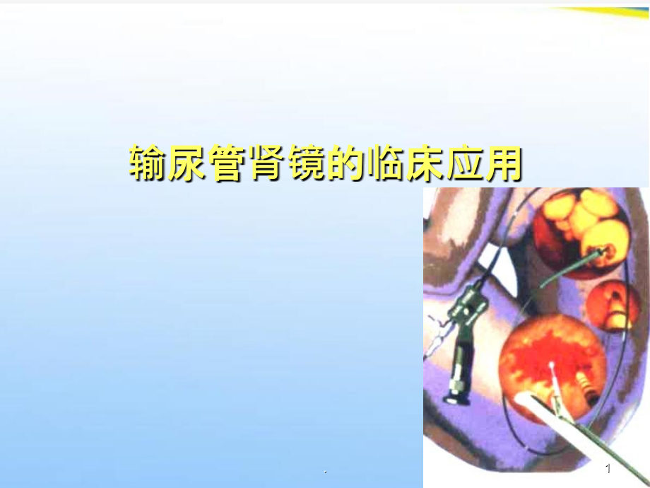 输尿管镜的临床应用.ppt_第1页
