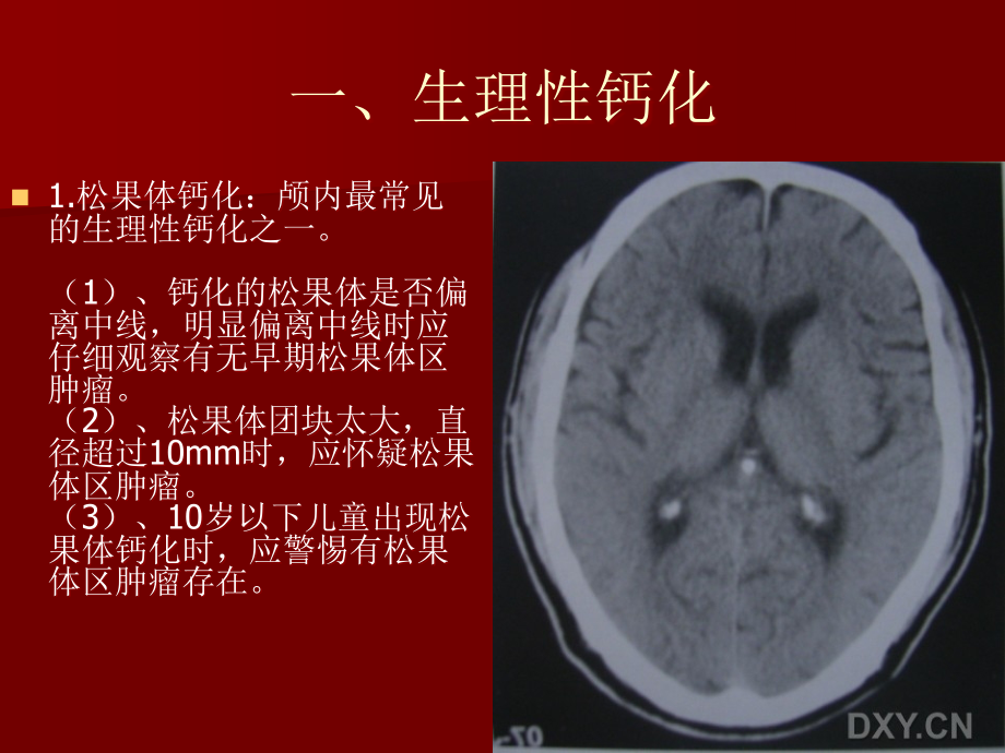 关于颅内钙化.ppt_第2页