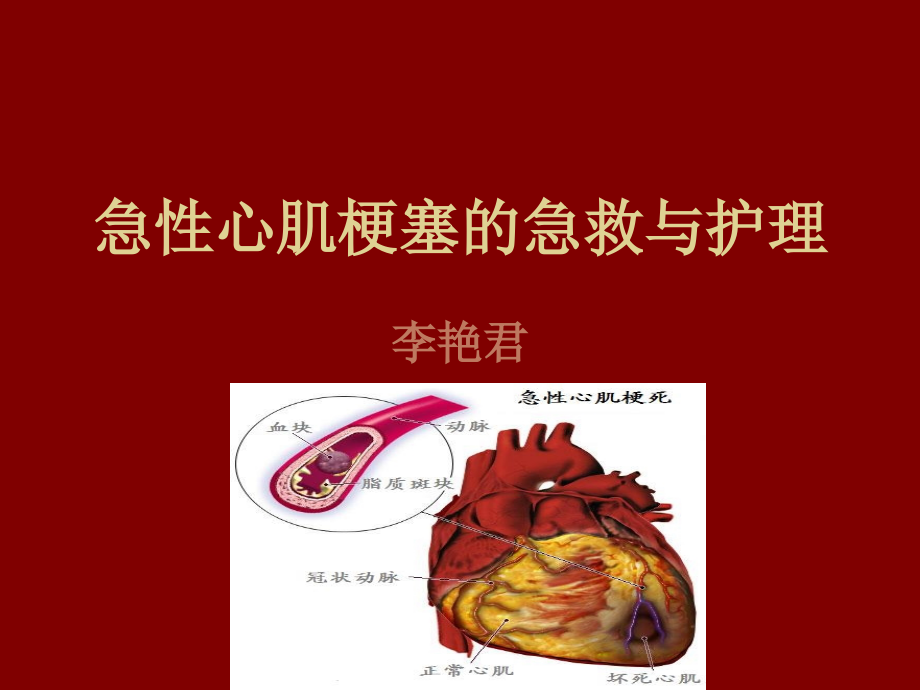 急性心肌梗死2.ppt_第1页