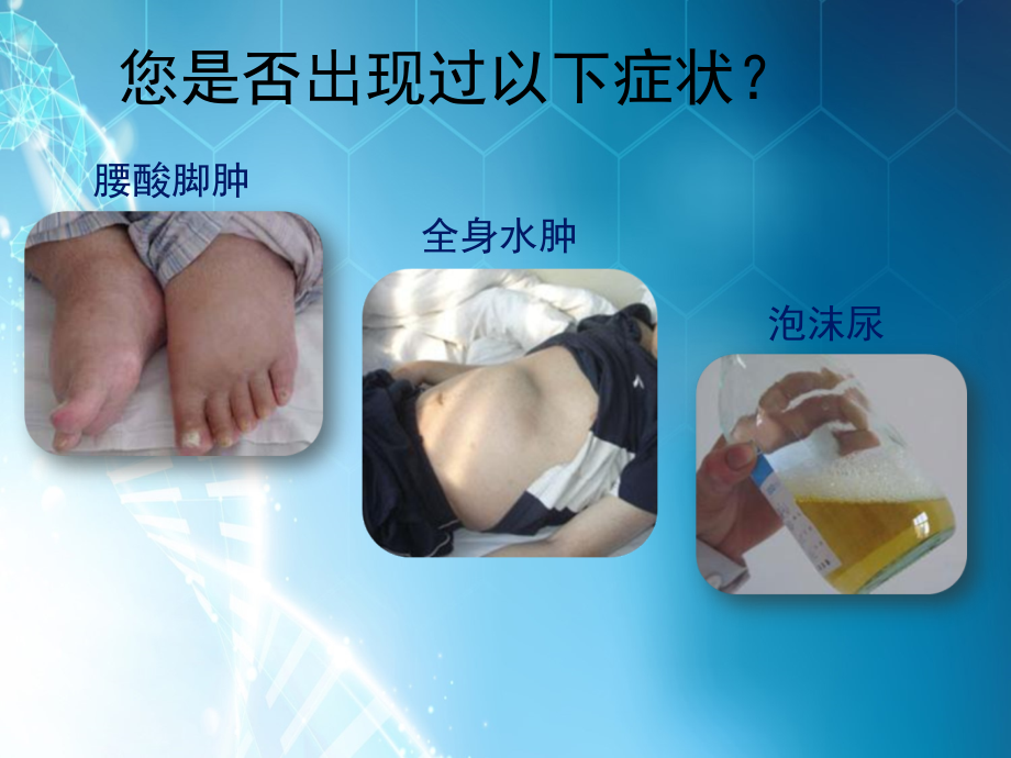 糖尿病肾病健康宣教.ppt_第2页