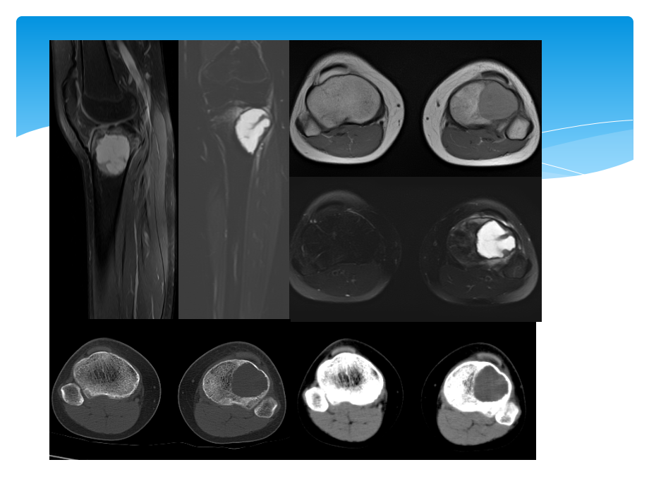 软骨母细胞瘤的影像诊断.ppt_第2页