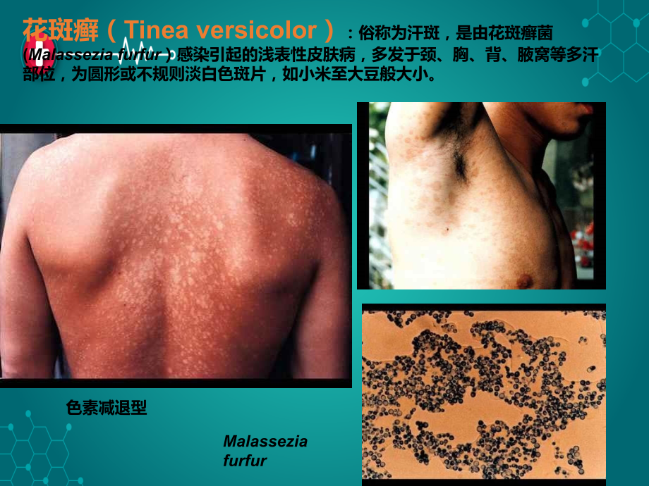 真菌疾病.ppt_第1页