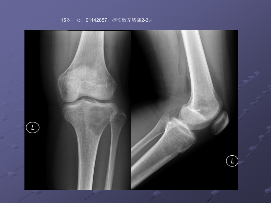 软骨母细胞瘤的影像诊断ppt课件.ppt_第1页