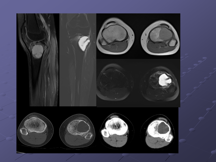 软骨母细胞瘤的影像诊断ppt课件.ppt_第2页