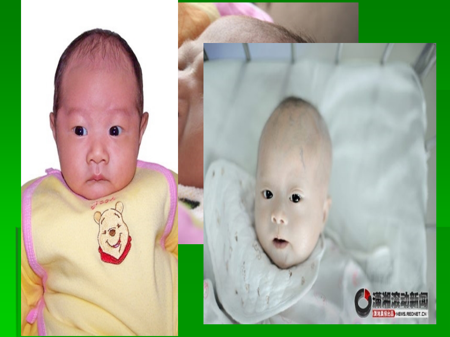 人类遗传病(精美).ppt_第2页
