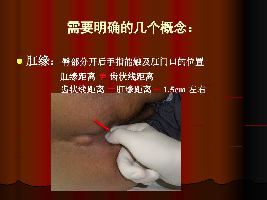 低位直肠癌术式选择及技巧.ppt_第2页