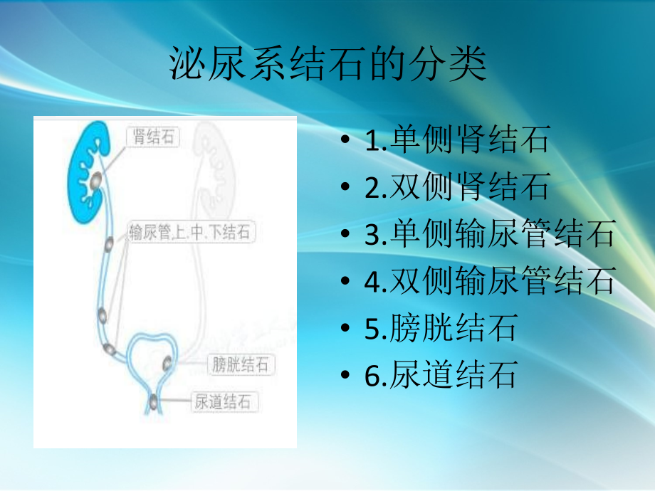 泌尿系结石的治疗.ppt_第2页