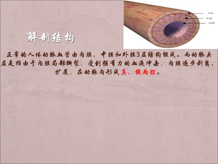 主动脉夹层pptppt课件.ppt_第2页