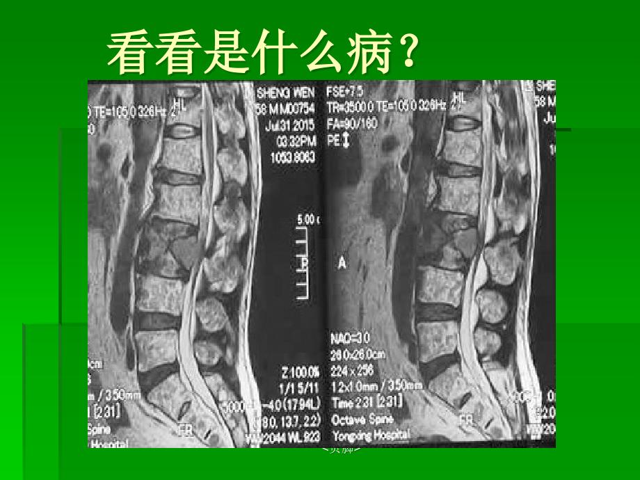 脊柱骨髓瘤.ppt_第2页