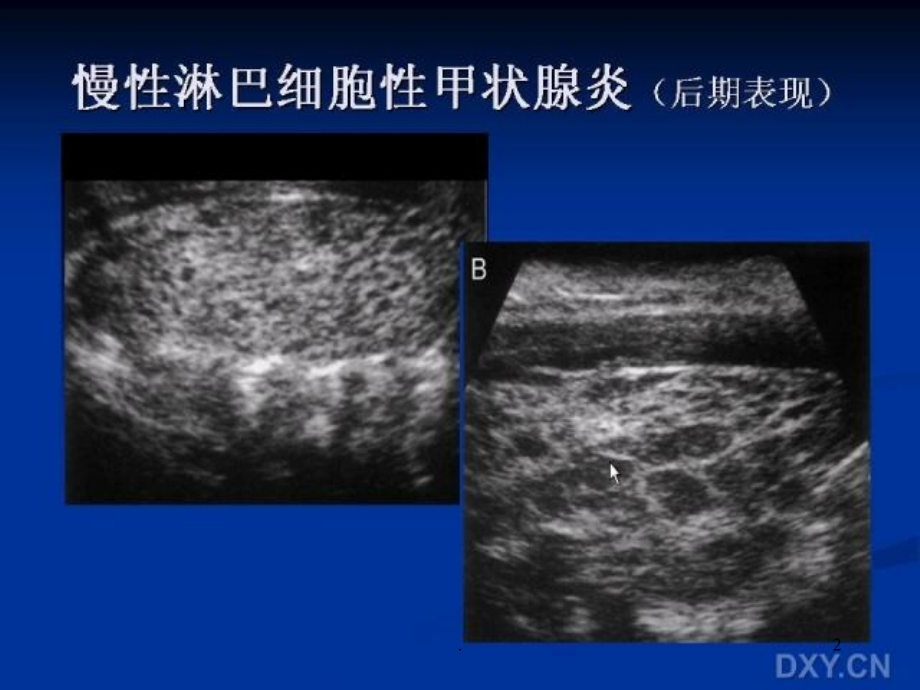 甲状腺疾病的超声诊断第三部分.ppt_第2页