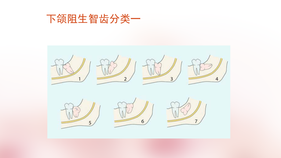 阻生牙的拔除.ppt_第2页