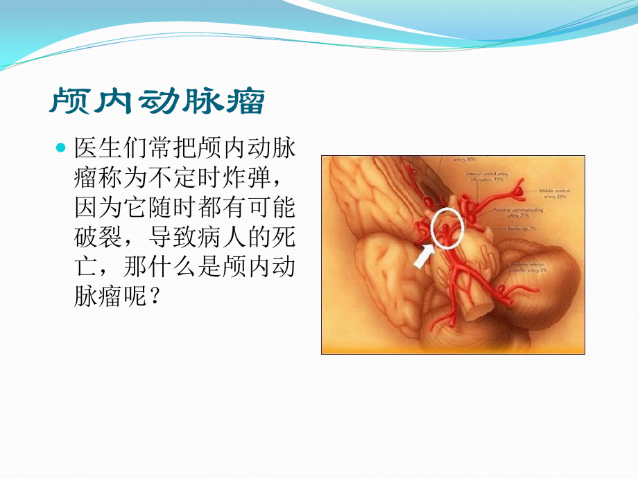 颅内动脉瘤夹闭手.ppt_第2页