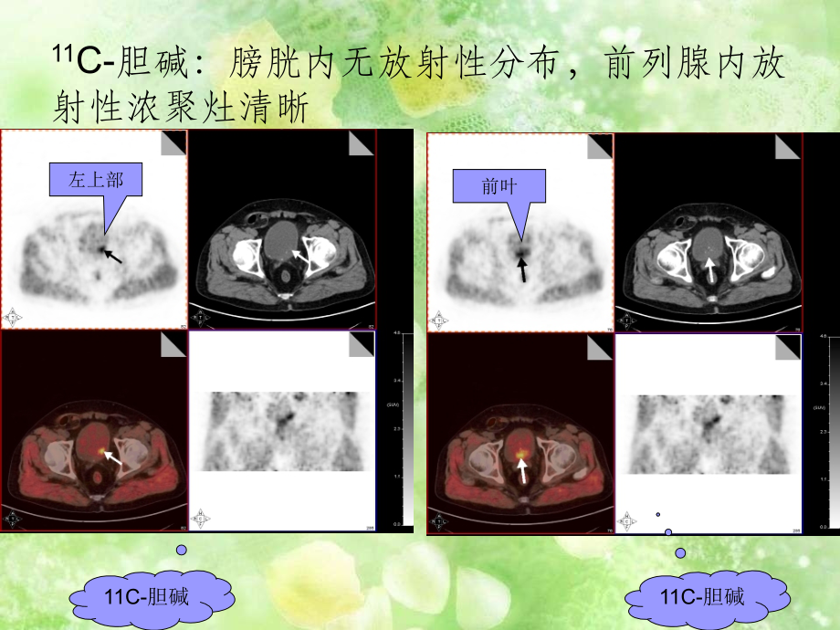 胆碱-E-C-前列腺癌.ppt_第2页