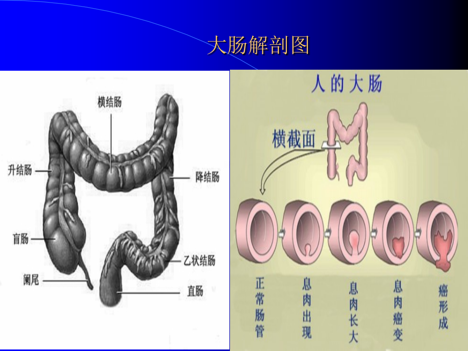 大肠癌观察和护理.ppt_第2页