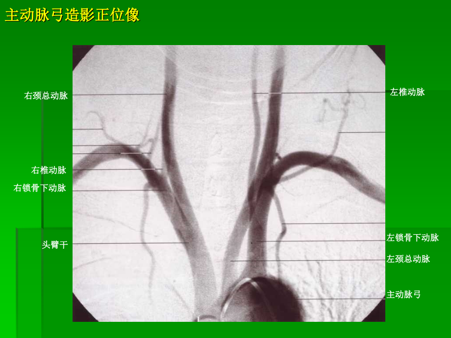 介入治疗解剖学图谱——神经血管.ppt_第2页