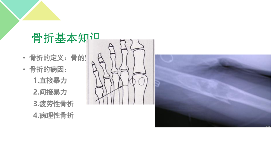 胫腓骨骨折(1).ppt_第2页