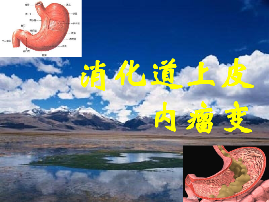 消化道上皮内瘤变.ppt_第1页
