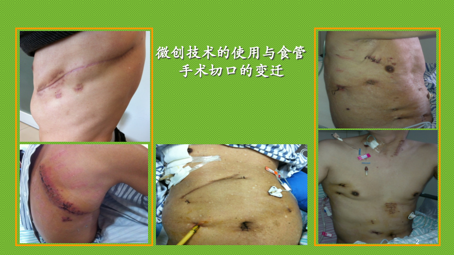 胸腹腔镜联合.ppt_第2页