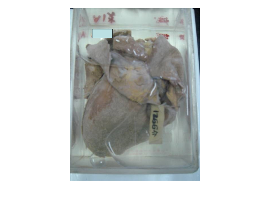 病理学实验：标本复习4.ppt_第2页