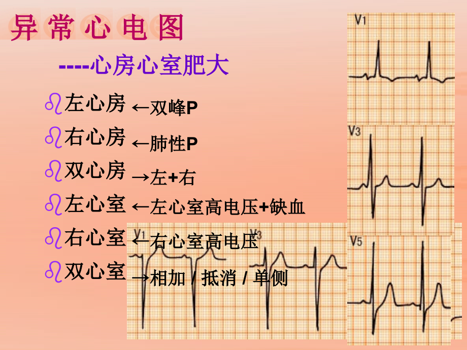 心电图(2)异常课件.ppt_第2页