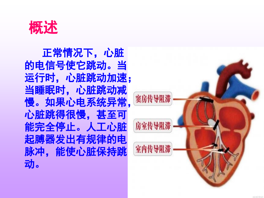 永久起搏器植入术围手术期护理课件.ppt_第2页