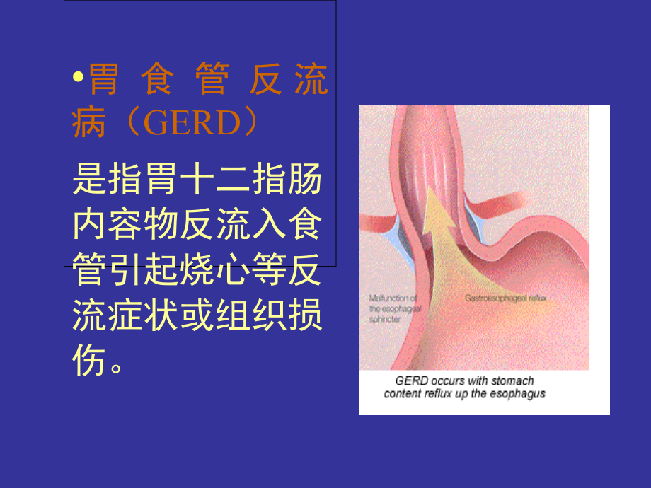 消化内科--胃食管反流病诊断与治疗课件.ppt_第2页