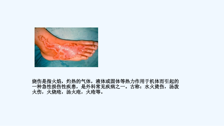 烧伤面积计算分期分度.ppt_第2页
