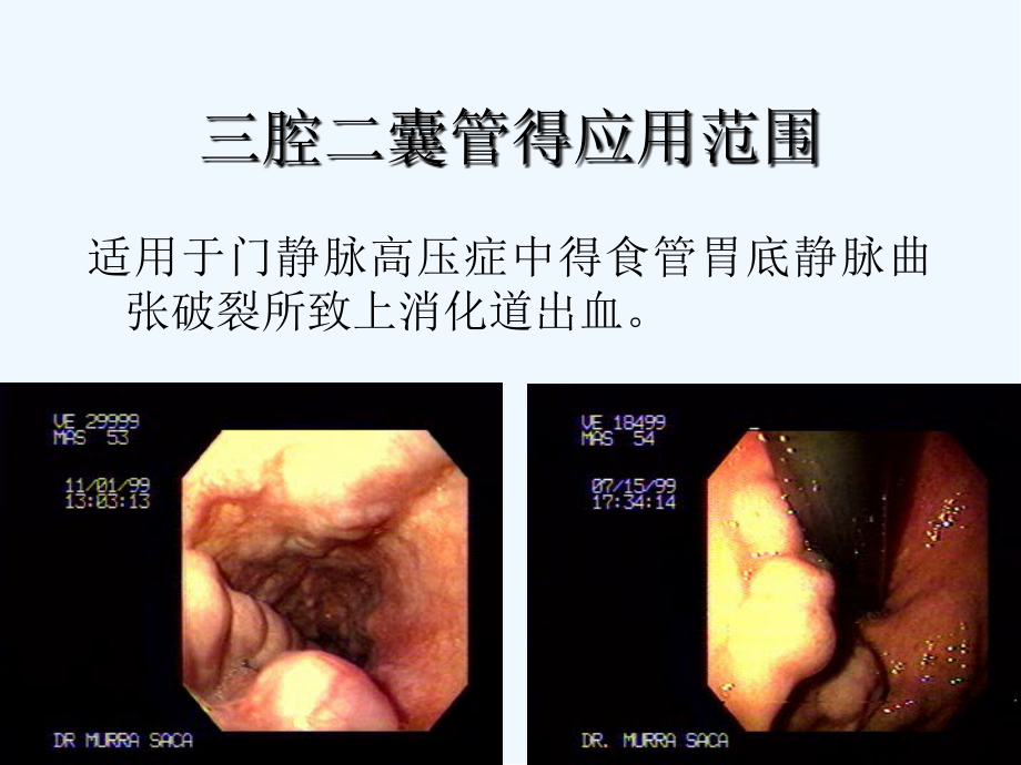 三腔二囊管.pptx_第2页