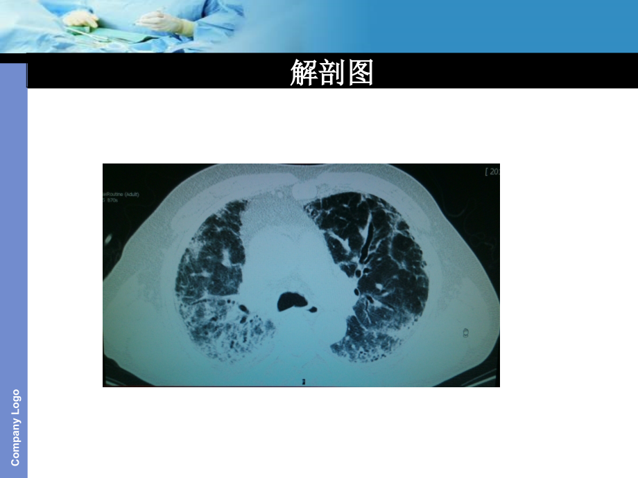 特发性肺间质纤维化医疗护理和查房课件.ppt_第2页