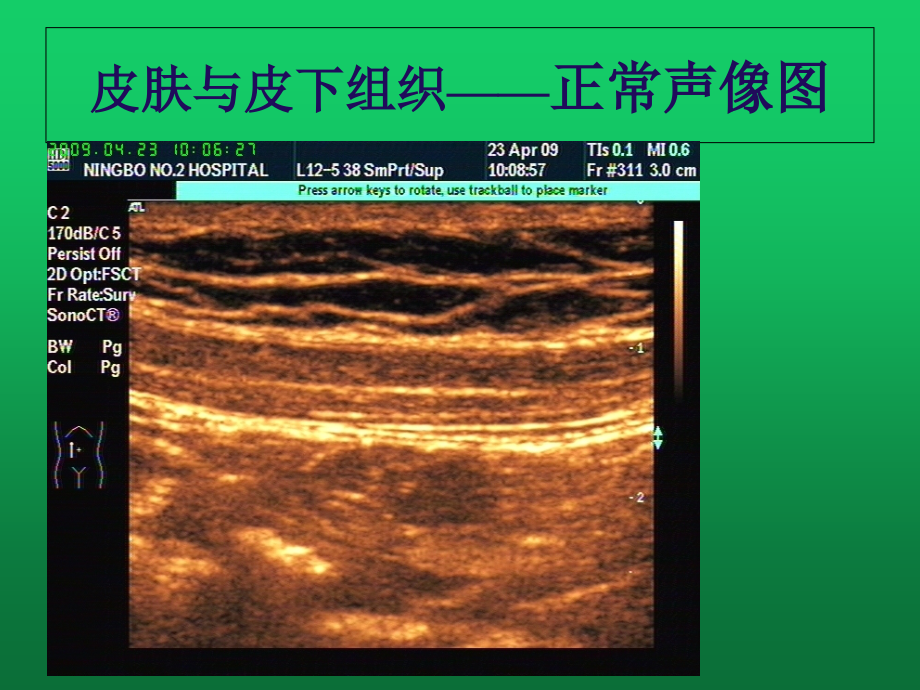 皮肤软组织肿块超声诊断课件.ppt_第2页