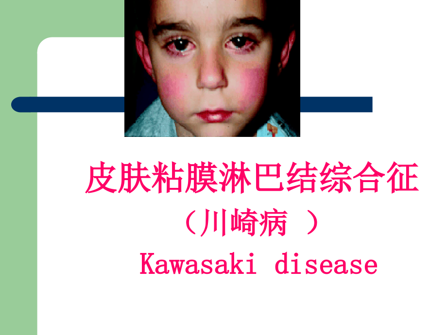 皮肤粘膜淋巴结综合征川崎病.pptx_第1页