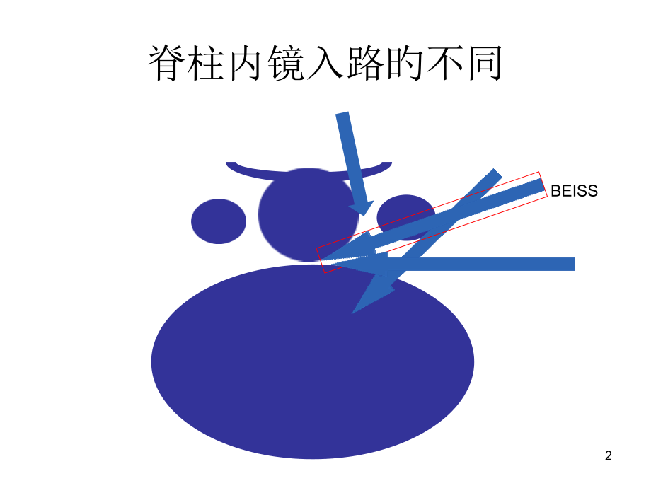 椎间孔镜Beis技术讲义.pptx_第2页