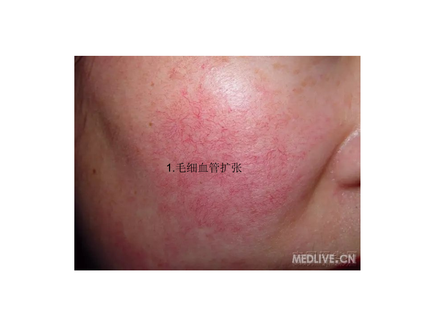 皮肤病图谱专题知识讲座.pptx_第2页