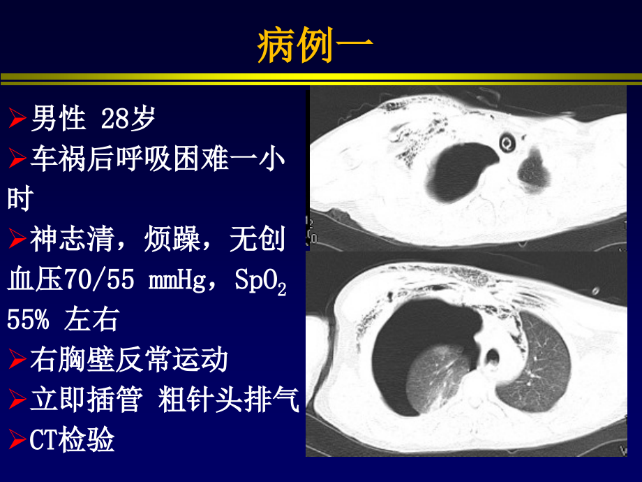 交通性气胸的机械通气.pptx_第2页