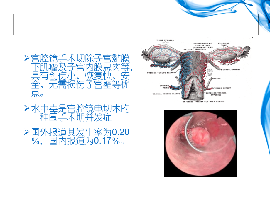 医学课件宫腔镜水中毒.pptx_第1页