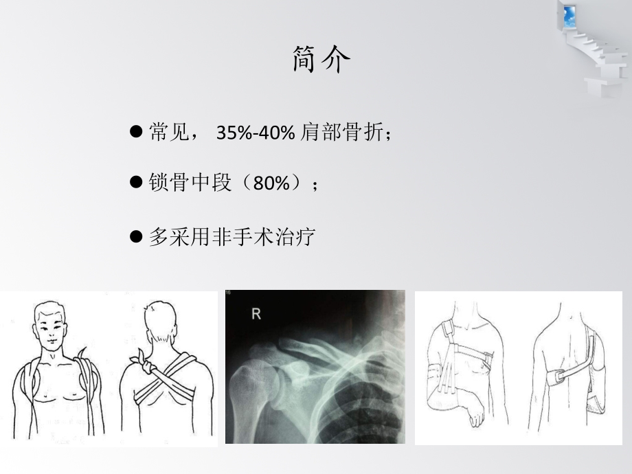 锁骨骨折切开复位内固定.pptx_第2页