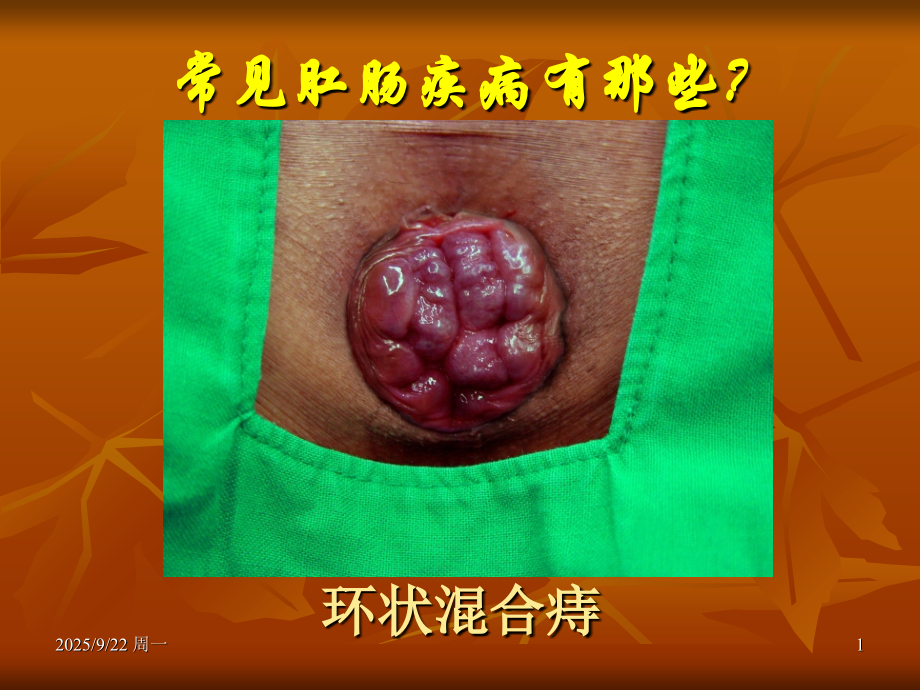肛肠科科普知识宣讲.ppt_第1页