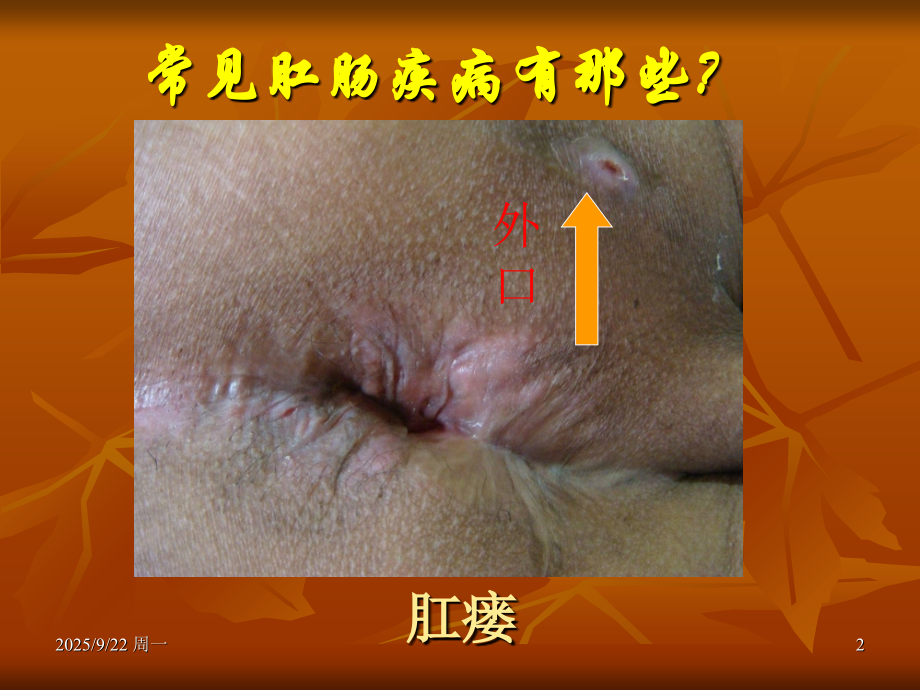 肛肠科科普知识宣讲.ppt_第2页