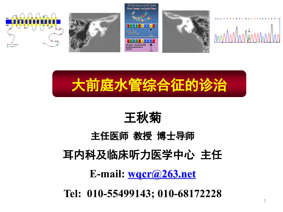 大前庭水管综合征的诊治-IOS讲课幻灯.pptx_第1页