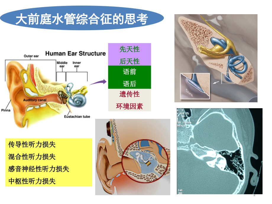 大前庭水管综合征的诊治-IOS讲课幻灯.pptx_第2页