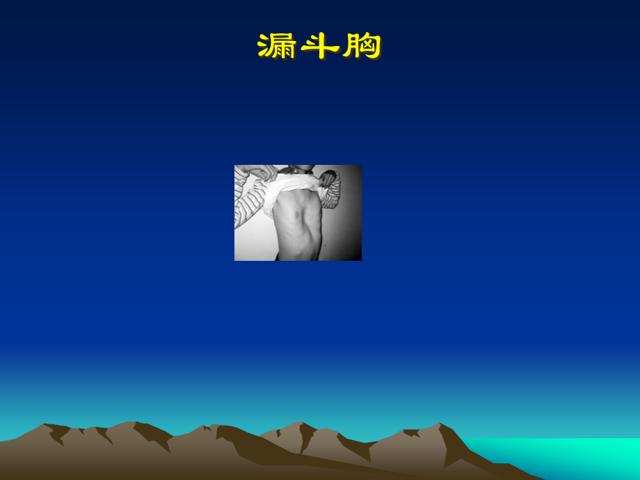 漏斗胸专题讲座.pptx_第1页