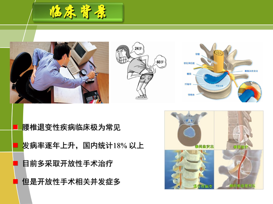 微创单侧固定腰间盘突出症课件.ppt_第1页