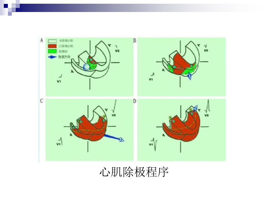 初学室性心动过速.ppt_第2页