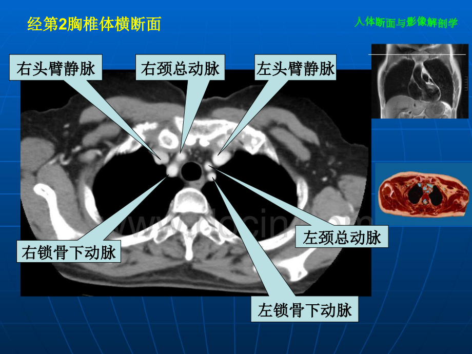 胸部CT全部介绍培训课件.ppt_第1页