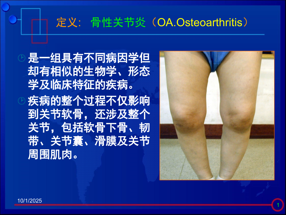 医学膝关节骨关节炎治疗进展课件.ppt_第2页