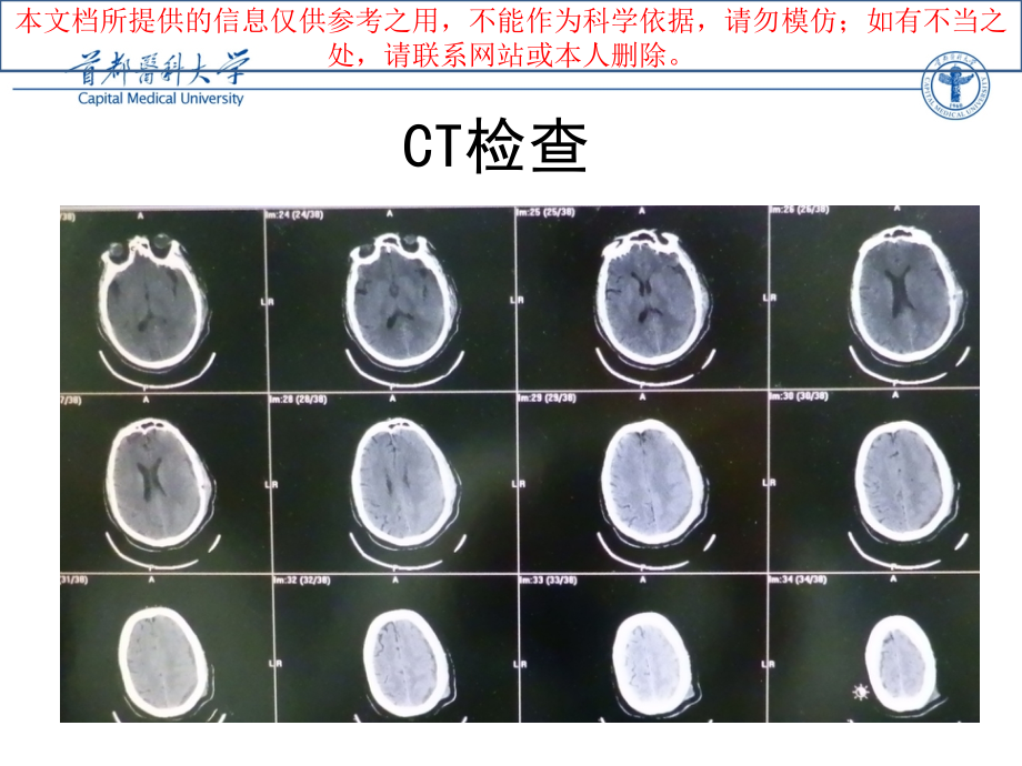 硬膜下血肿术后癫痫持续状态简单培训课件.ppt_第2页