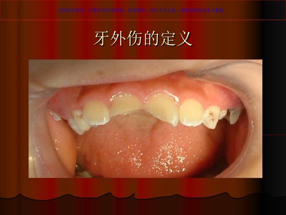 年轻恒牙外伤临床处理课件.ppt_第1页